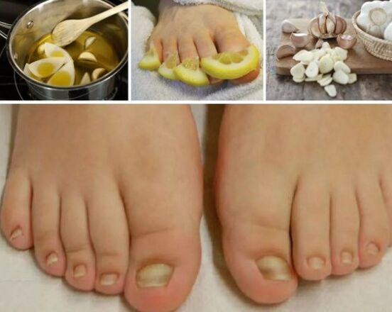 People's treatment for nail fungi