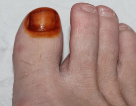 The treatment of fungi is iodine