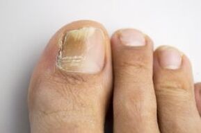 Illness with a mushroom