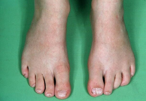 Mushrooms in the legs