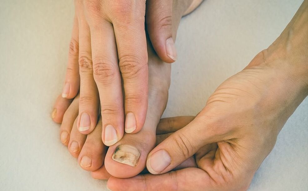 How to treat nail fungus