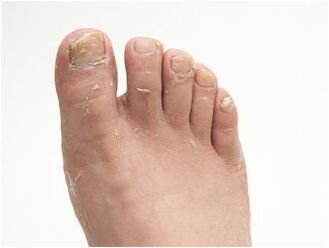 symptoms of foot fungus