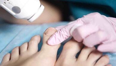 Hardware treatment of fungi in the legs