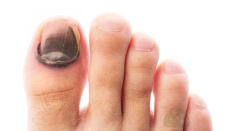 Running phase of the disease with the mushroom of the thumb nail