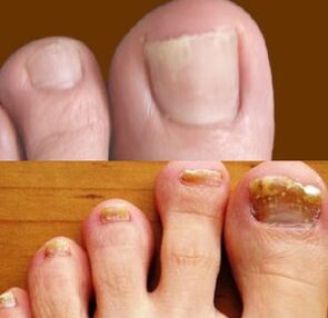 initial and advanced stages of athlete's foot