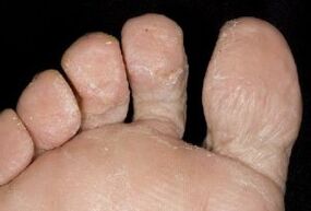 signs of fungus on the skin of the feet