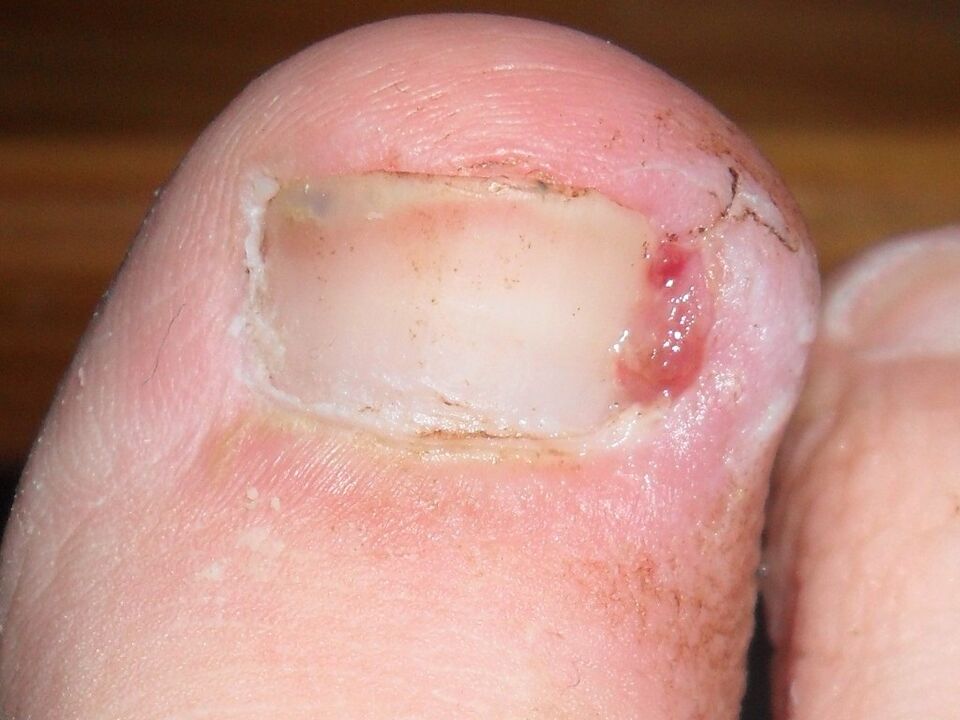 ingrown toenails as a sign of fungal infection