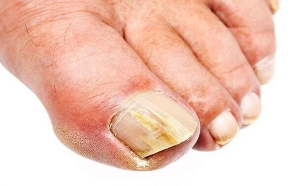 Onychomycosis - nail fungus