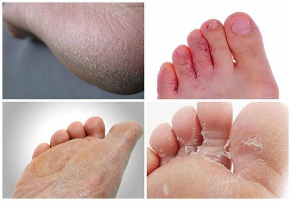 The main manifestations of mycosis of the feet are keratinization of the skin, cracks, peeling
