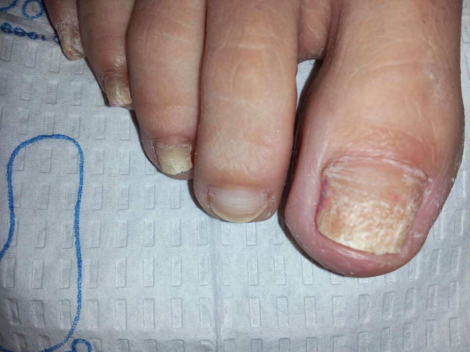 How to treat nail fungus with celandine
