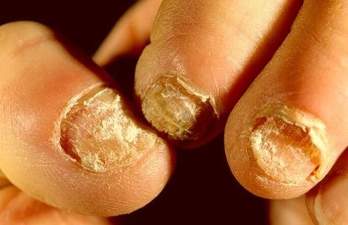 how to treat nail fungus