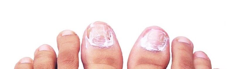 nail ointment for fungus