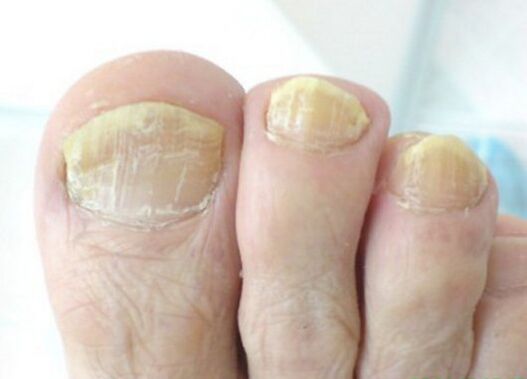 fungus developed on toenails