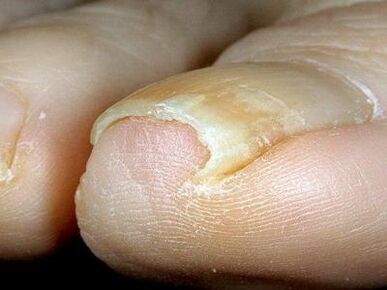 The appearance of infected toenails